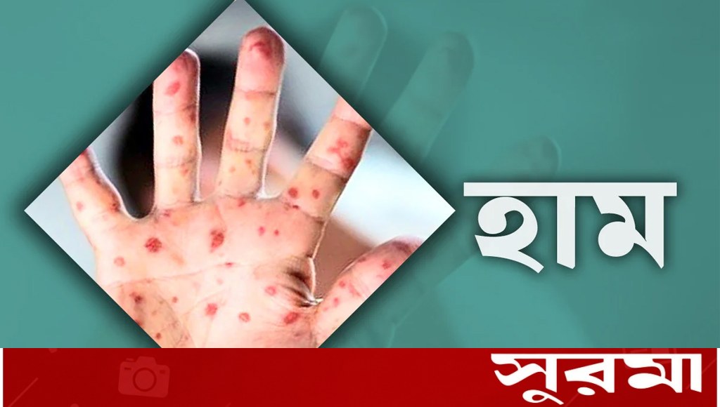 হামের উপসর্গ: ২৪ ঘণ্টায় মৃত্যু ৮ শিশুর