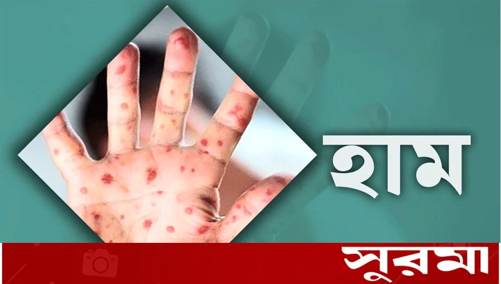 হাম উপসর্গে আরও ৭ জনের মৃত্যু